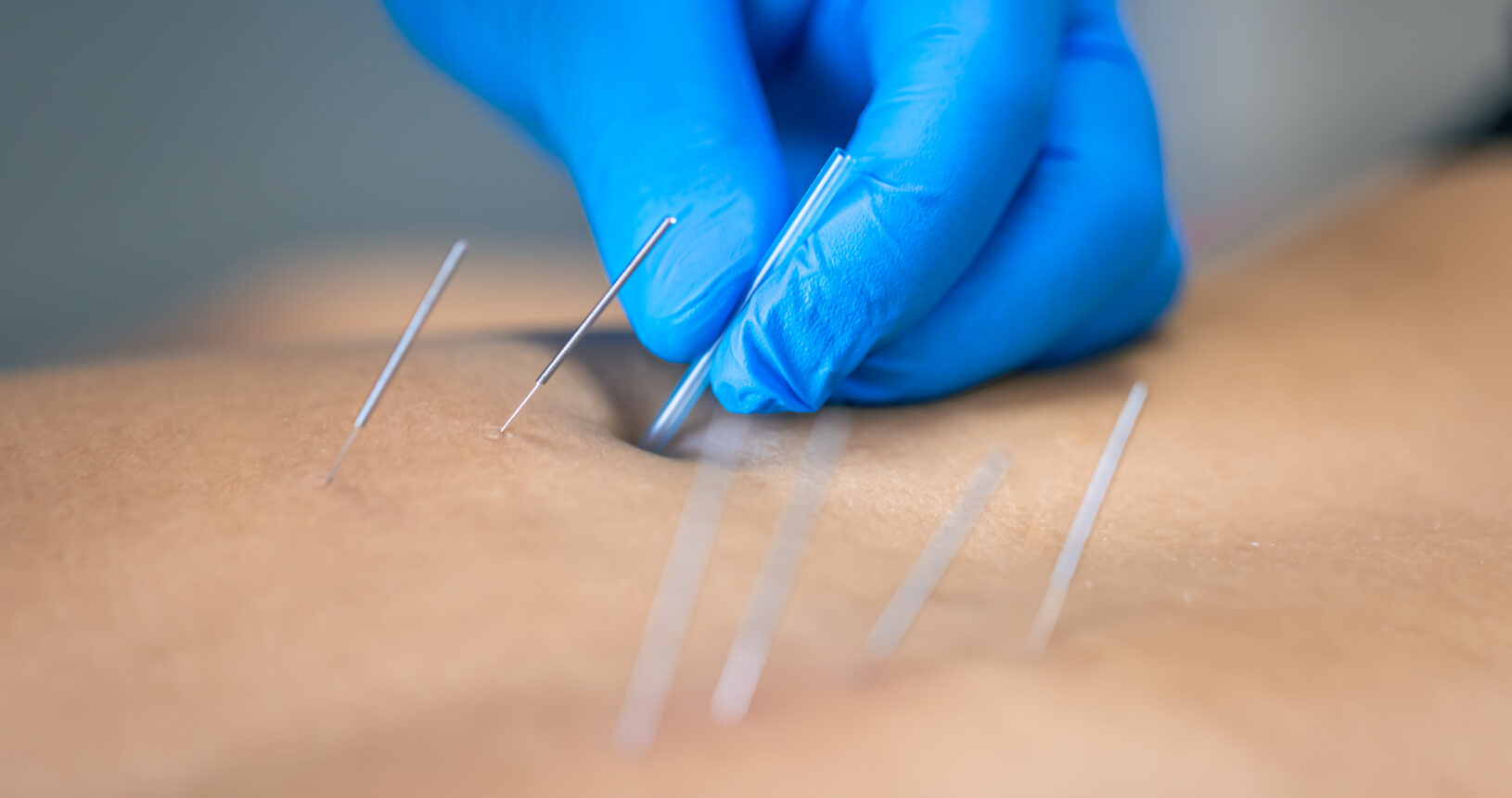 suche igłowanie, dry needling Opalenica
