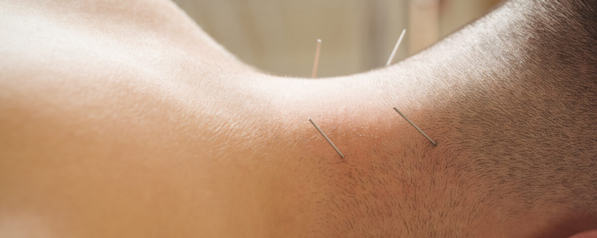 suche igłowanie, terapia manualna Opalenica