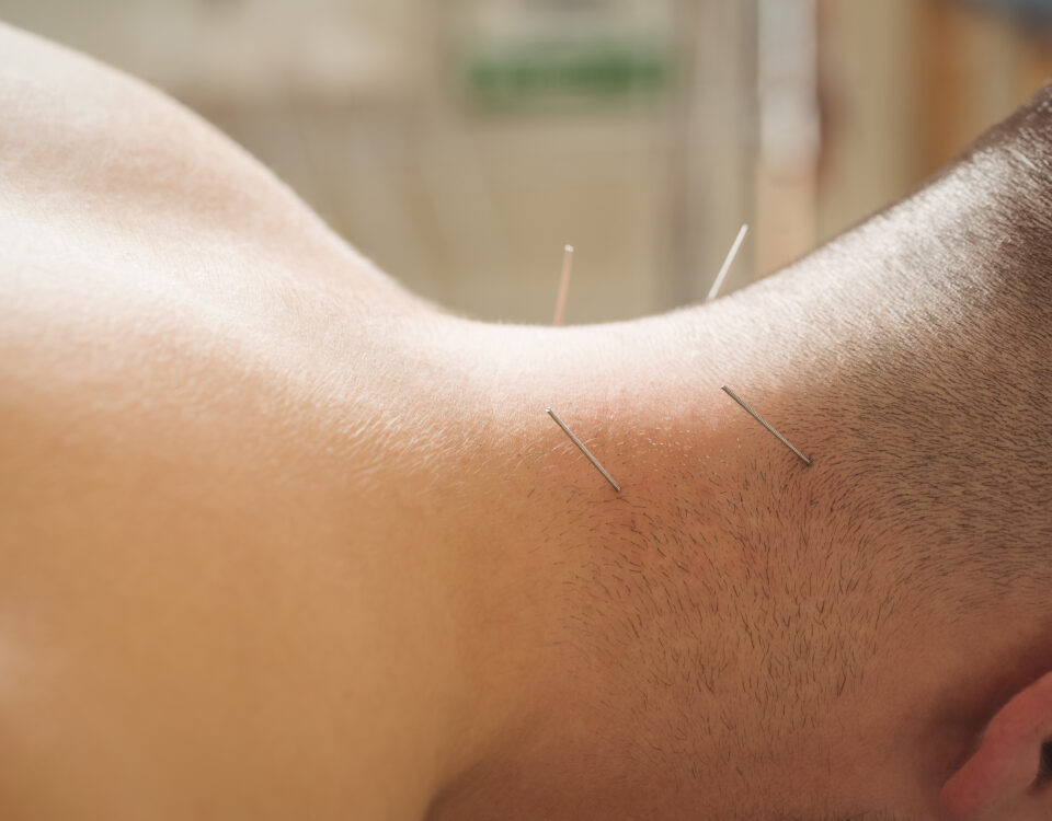 suche igłowanie, terapia manualna Opalenica