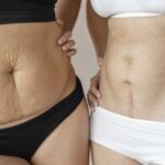 terapia blizn, fizjoterapia uroginekologiczna