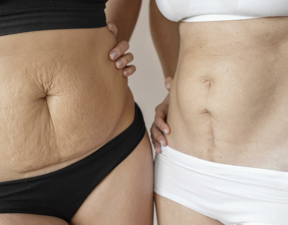 terapia blizn, fizjoterapia uroginekologiczna